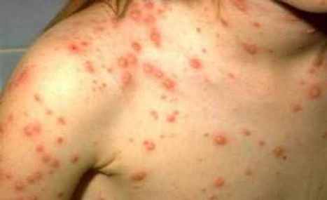 typhus fever