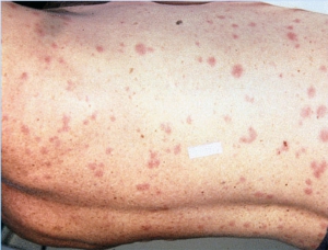 typhus fever