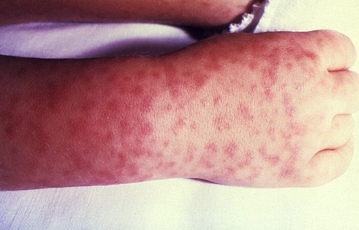 typhus fever