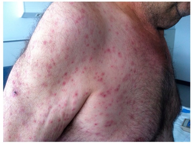 typhus fever